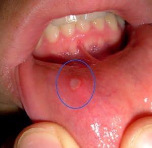 canker sore